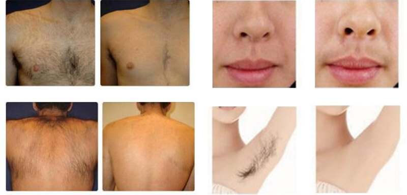 laser hair removal treatment before  and after