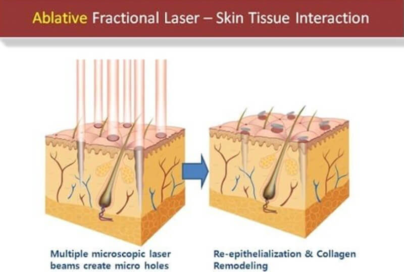 co2 fractional laser treatment