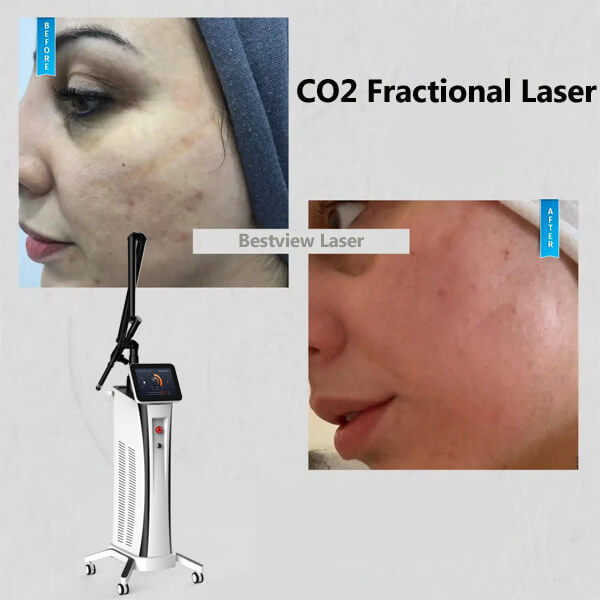 What results should expect of CO2 fractional laser treatment?