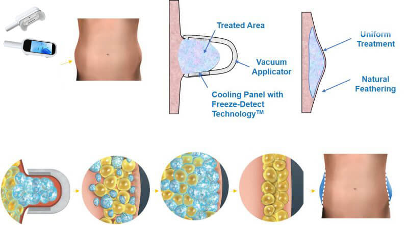 cryolipolysis treatment