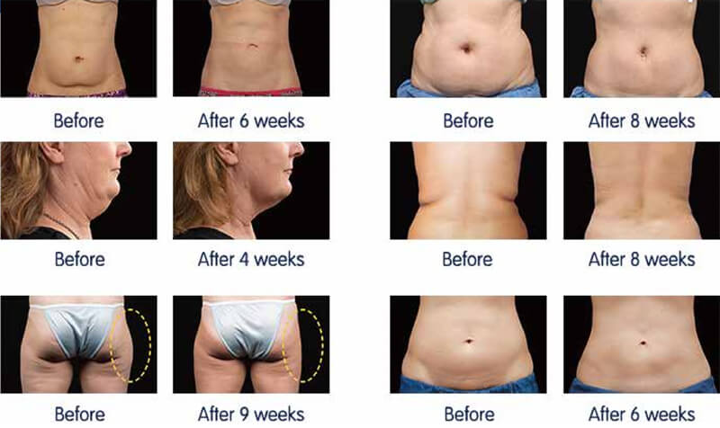 cryolipolysis treatment before and after