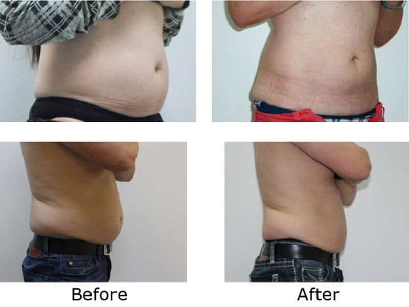 cryolipolysis treatment before and  after