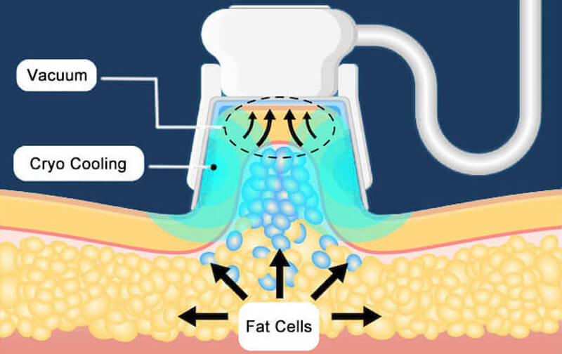 cryolipolysis treatment