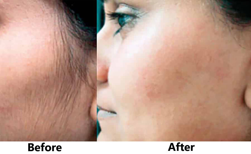 diode laser for face hair removal
