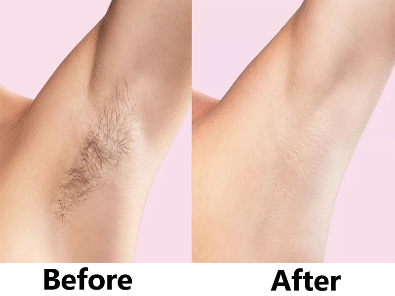 laser hair removal treatment before and after