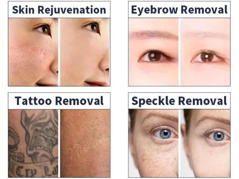 picosecond laser treatment before and after