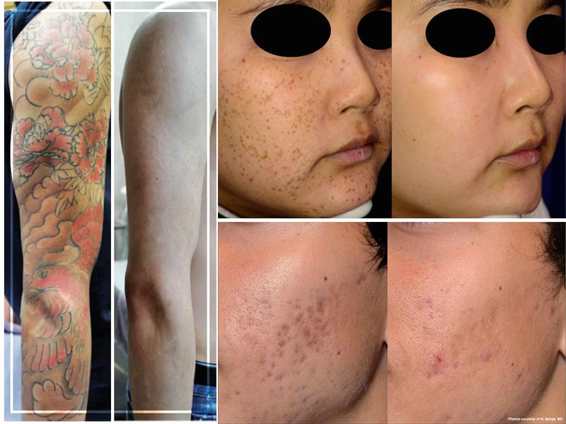 picosecond laser treatment before and after