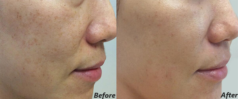 picosecond laser melasma