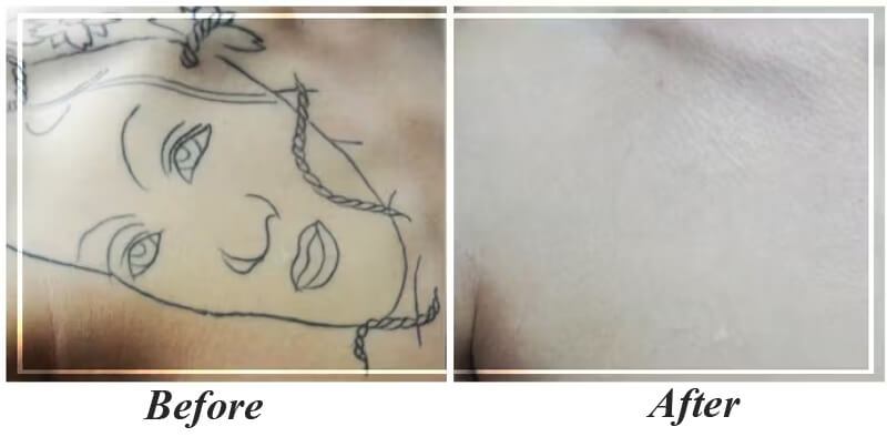 picosecond laser tattoo removal treatment before and after