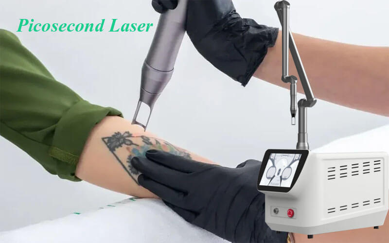 picosecond laser tattoo removal machine