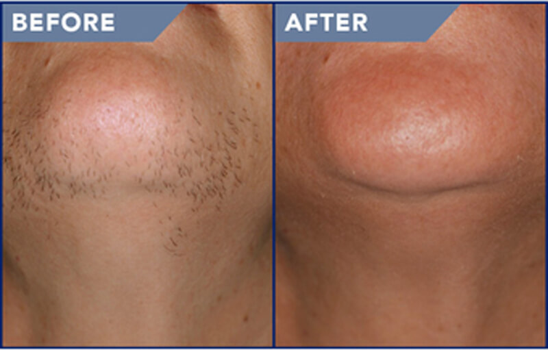 laser hair removal treatment before and after