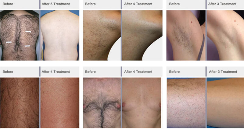 laser hair rremoval treatment before and after