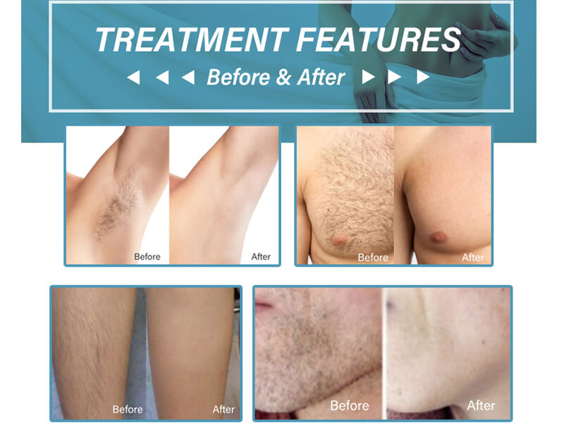 laser hair removal treatment before and after