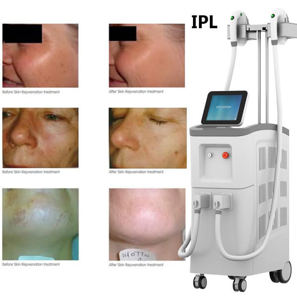 What skin conditions does IPL treatment?