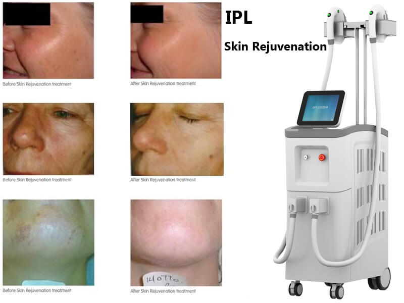 IPL skin rejuvenation machine