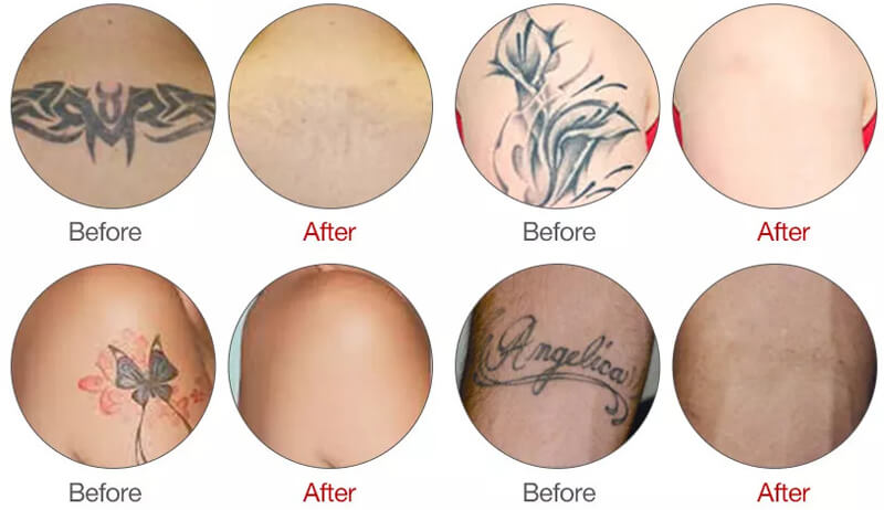 nd yag laser treatment before and after