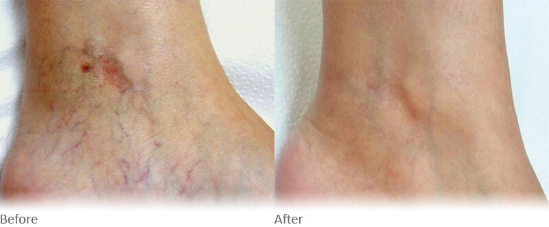 nd yag laser treatment