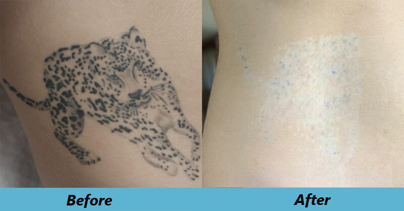 picosecond laser treatment before and after