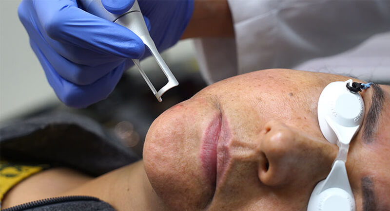 picosecond laser treatment