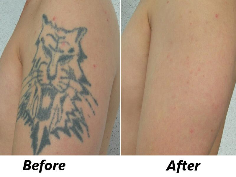 picosecond laser treatment before and after