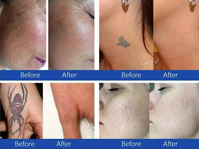 picosecond laser treatment before and after