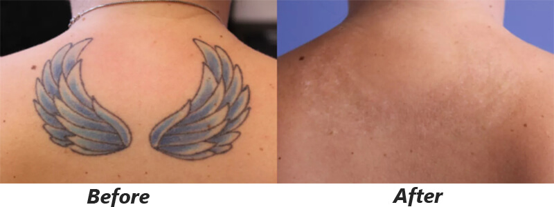 picosecond laser treatment before and after