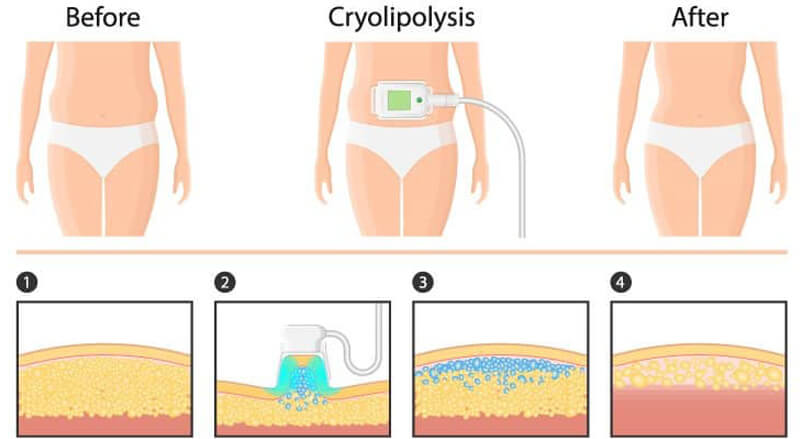 cryolipolysis treatment