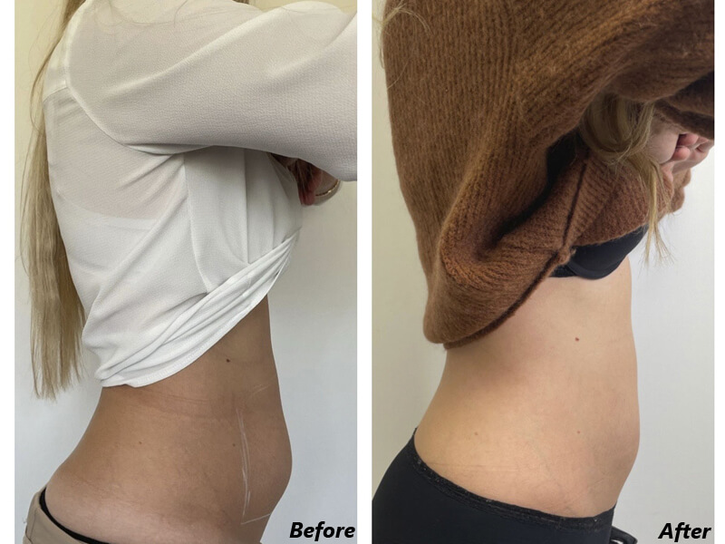 cryolipolysis treatment