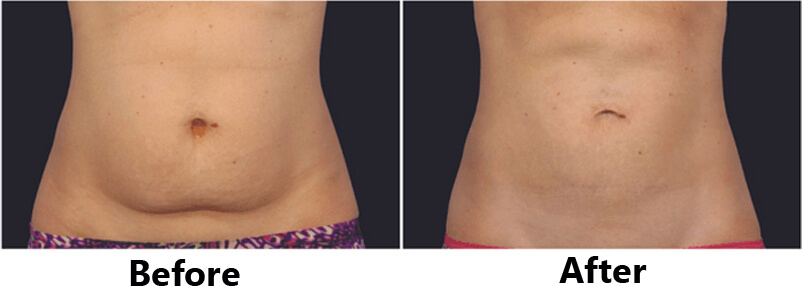 cryolipolysis treatment before and after