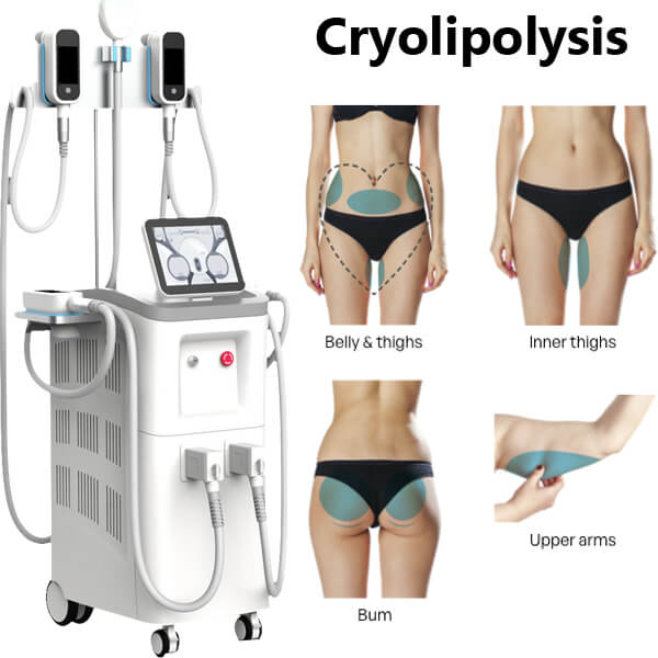 Cryolipolysis combats fat accumulation with a cell-freezing cold treatment