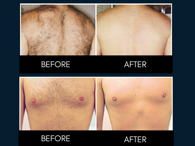 diode laser hair removal treatment before and  after