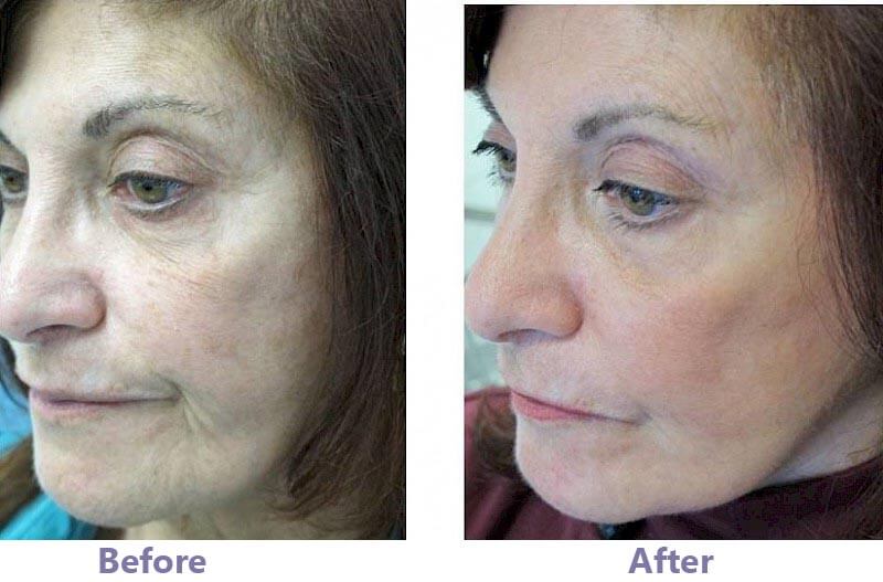 co2 fractional laser treatment