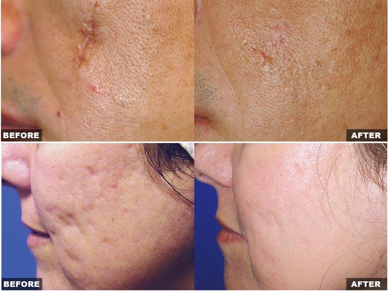 co2 fractional laser treatment