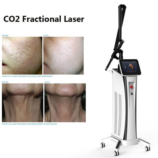 Things you need to know about CO2 laser treatment