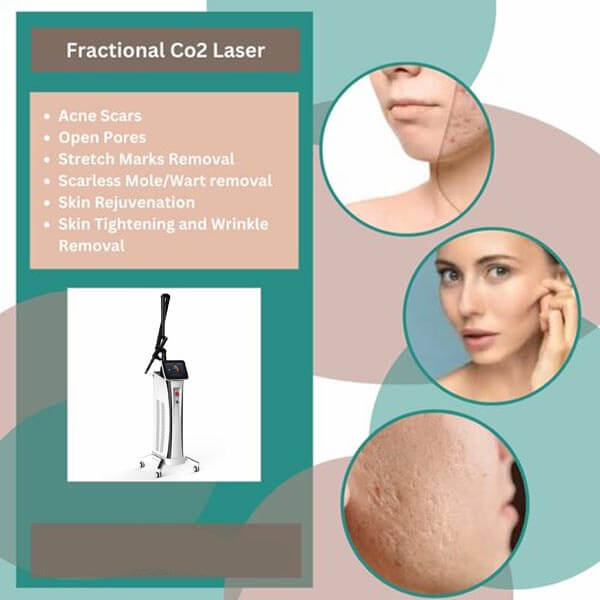 Fractional CO2 Laser: Essential Things You Should Know About This Acne Scar Treatment