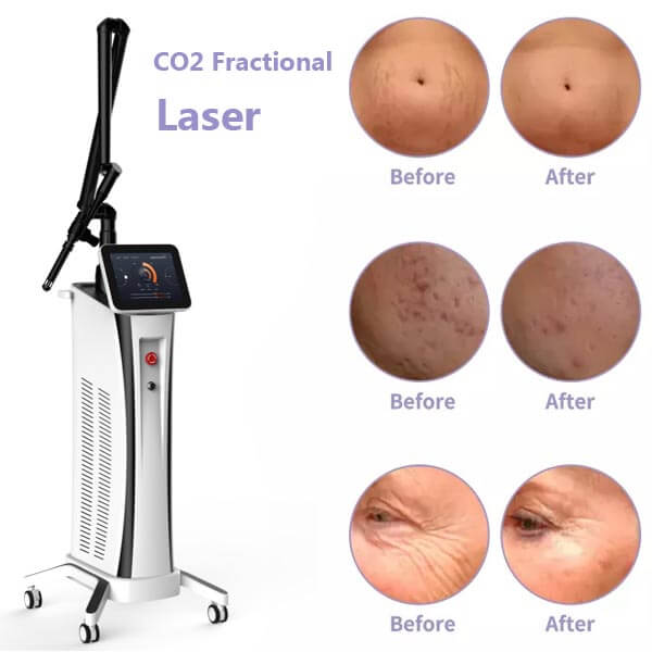 Complete Guide to CO2 Laser Resurfacing