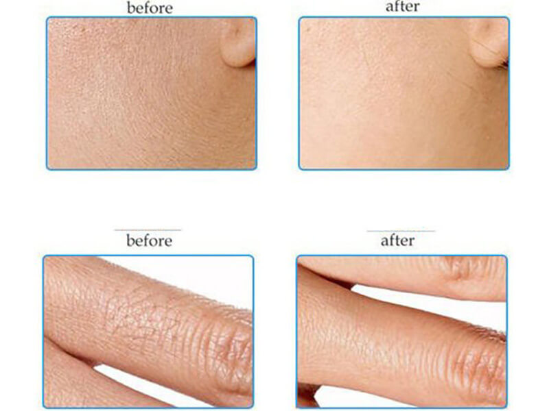 diode laser treatment