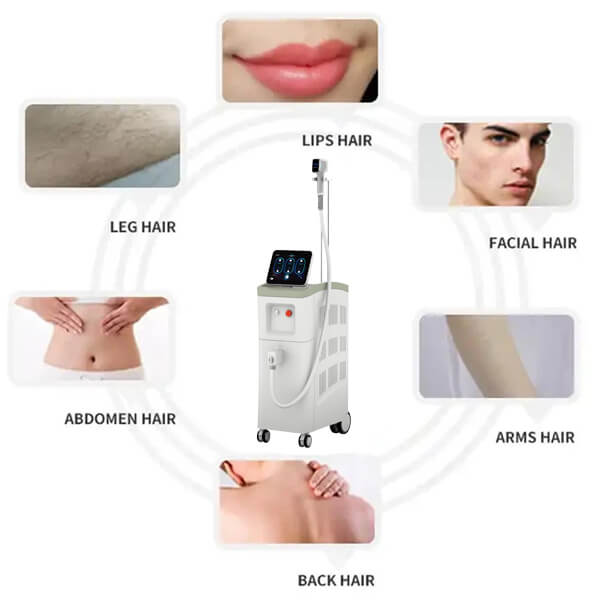 Diode Laser Hair Removal – Mechanism, Benefits and Queries!