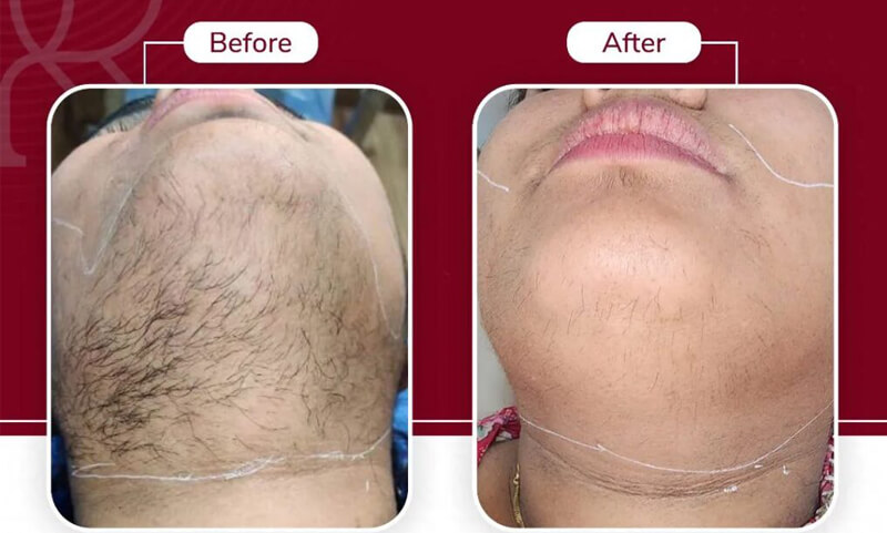 diode laser treatment