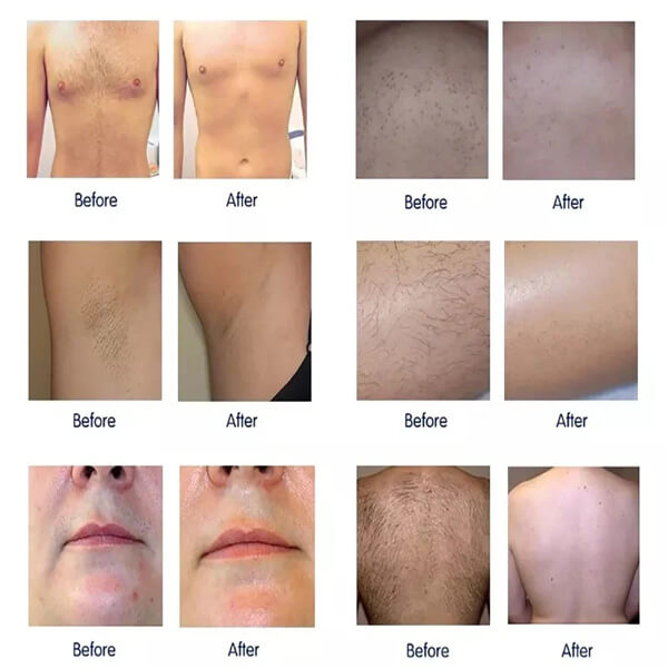 Diode laser: full understanding about permanent laser hair removal treatment