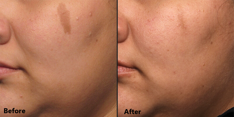 picosecond laser treatment