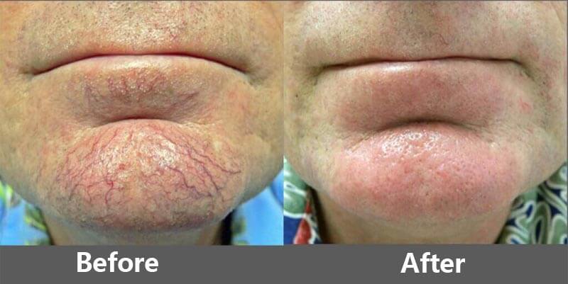 erbium laser resurfacing