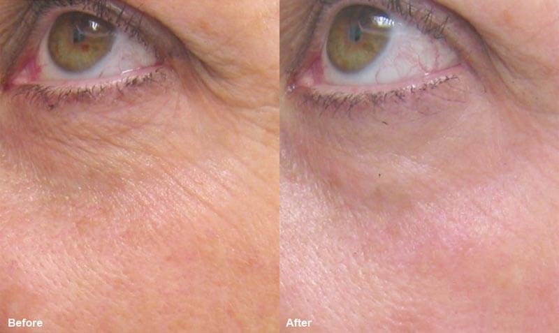 erbium laser resurfacing