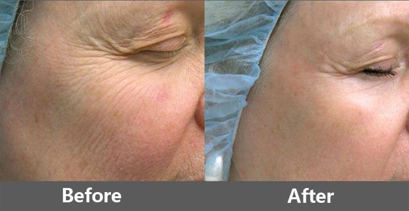 erbium laser resurfacing