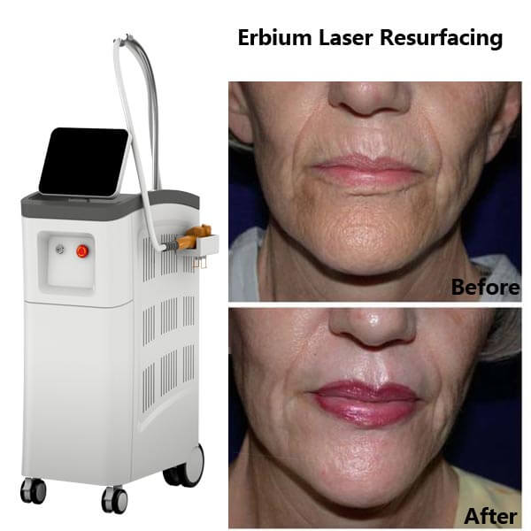 Fractional resurfacing lasers: Erbium laser