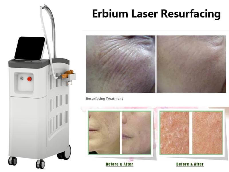 erbium laser machine