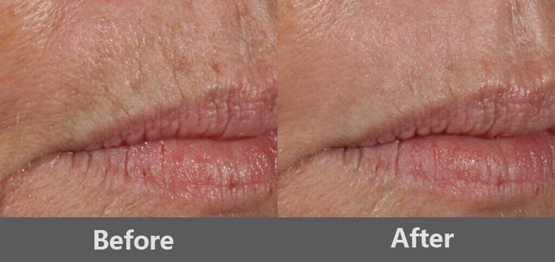 erbium laser resurfacing treatment