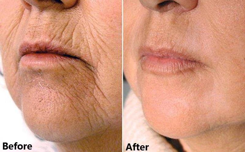 erbium laser resurfacing