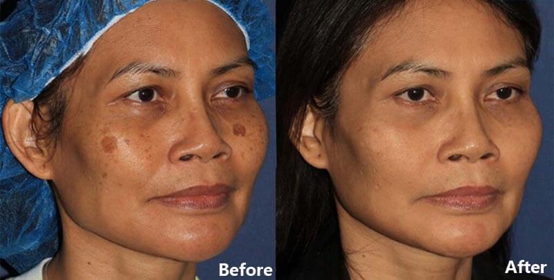 picosecond laser treatment