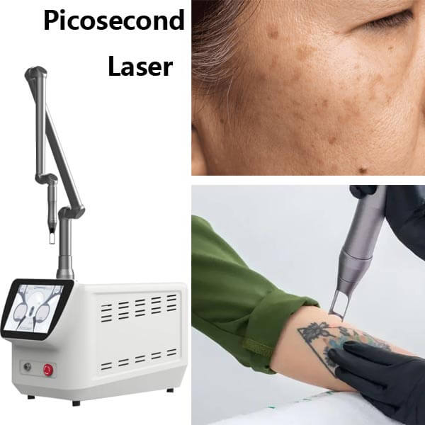 Picosecond Laser vs. Q-Switched Laser for Pigmentation Treatment